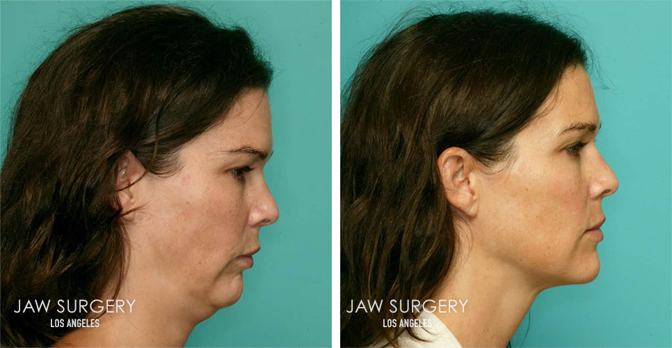Before and After Patient Photo - Jaw Surgery 14