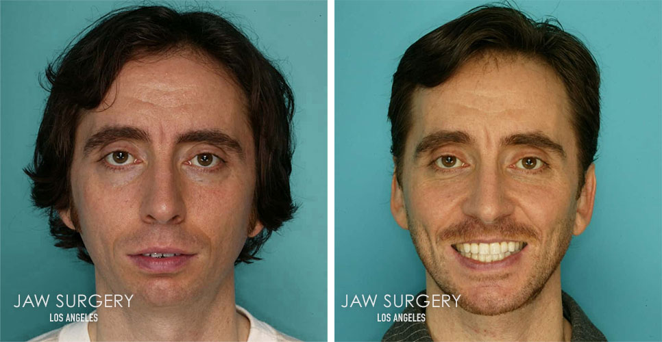 Before and After Patient Photo - Jaw Surgery 16