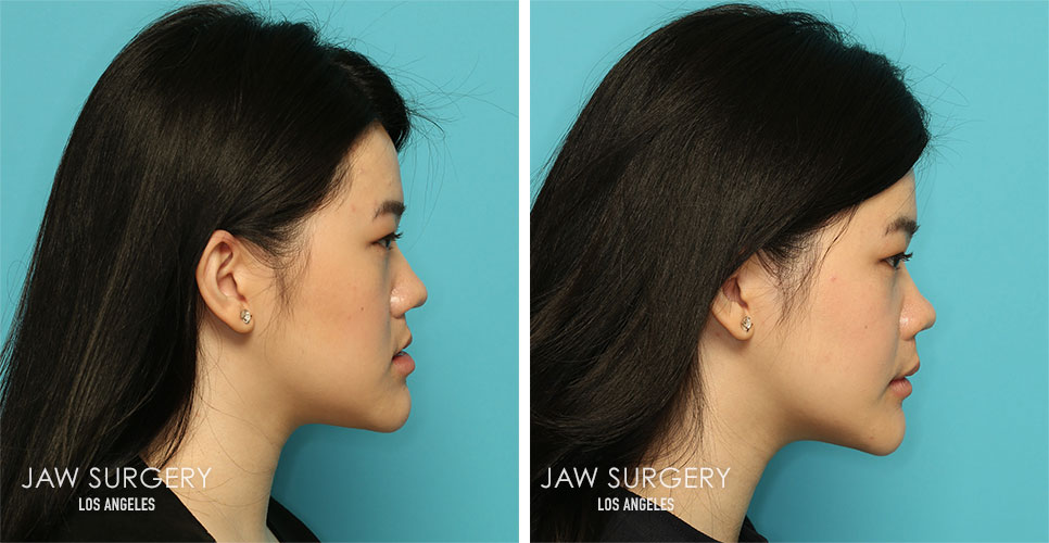 Before and After Patient Photo - Jaw Surgery 19