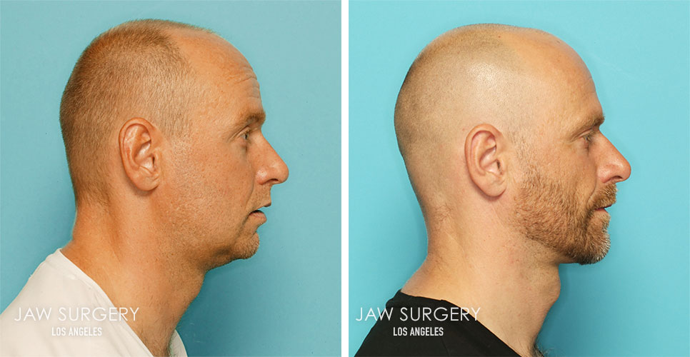 Before and After Patient Photo - Jaw Surgery 20