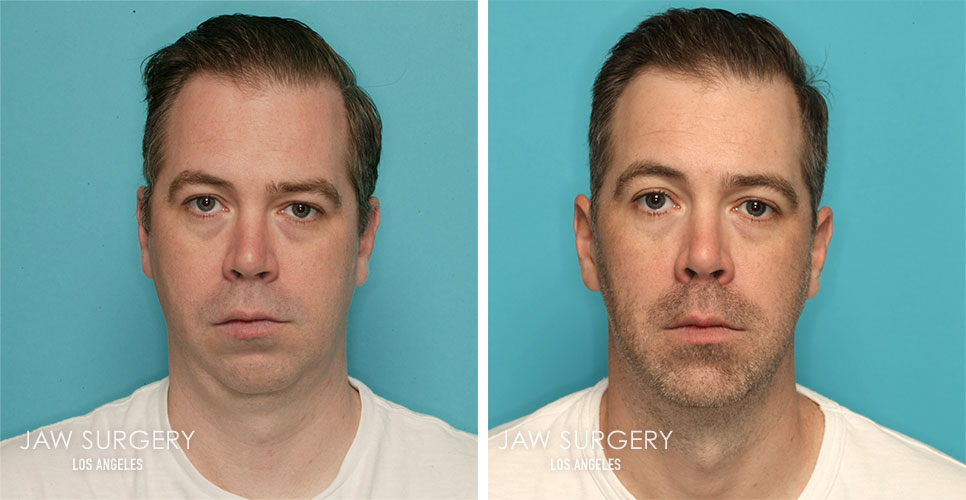 Before and After Patient Photo - Jaw Surgery 21